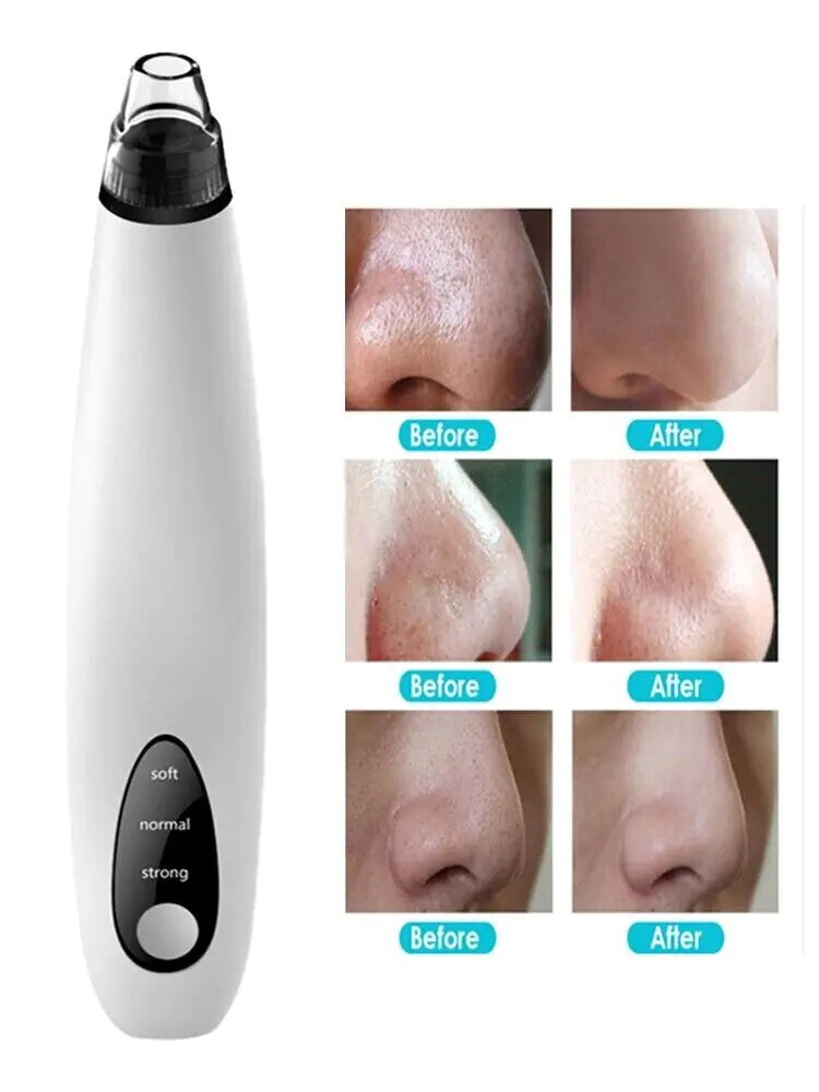 DiamondGlow Blackhead Remover Vacuum